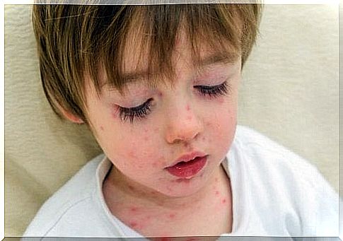 Chickenpox is one of the contagious diseases that we find a lot in school.