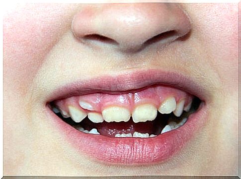 Displaced teeth in children: what to do?