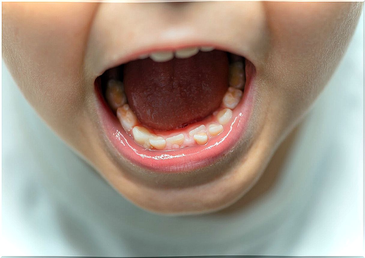 A child's mouth with displaced teeth.