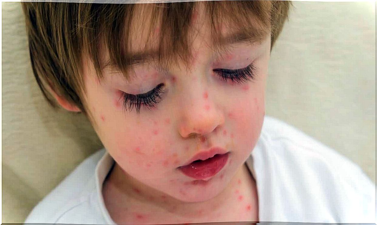 Everything you didn't know about scarlet fever