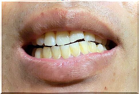 The appearance of stains on permanent teeth