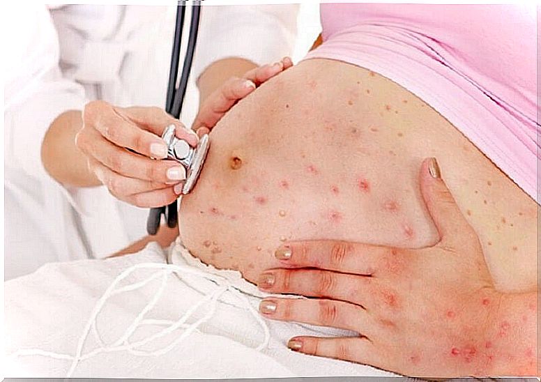 What is congenital chickenpox?